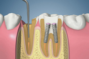 Broken Tooth Root Canal Treatment-Post and Crown
